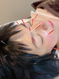 Les soins d'acupuncture esthétique du visage 
